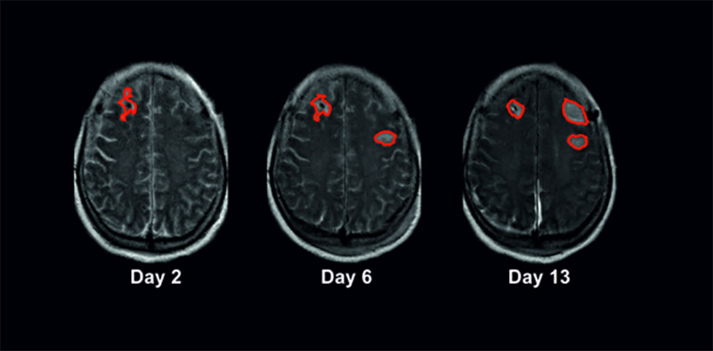 Imagen: Imágenes de resonancia magnética del cerebro tomadas los días 2, 6 y 13 después de una hemorragia subaracnoidea (Fotografía cortesía de Charité – Universitätsmedizin Berlin)