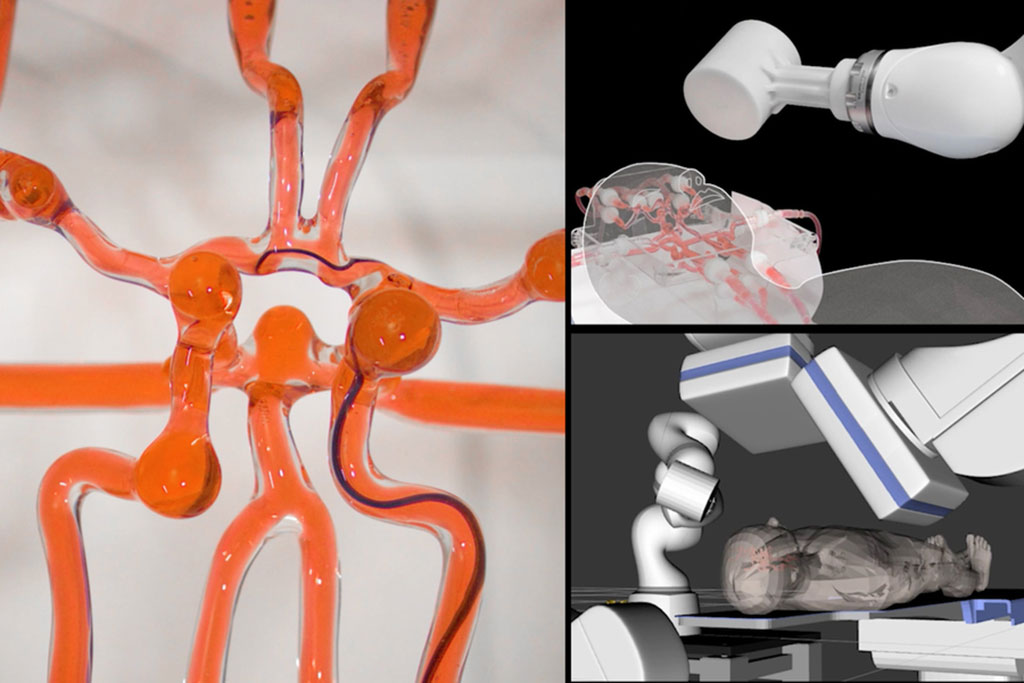 Imagen: Los ingenieros del MIT desarrollaron un sistema telerrobótico para ayudar a los cirujanos a tratar de forma remota a los pacientes que sufren un accidente cerebrovascular o un aneurisma (Fotografía cortesía del MIT)