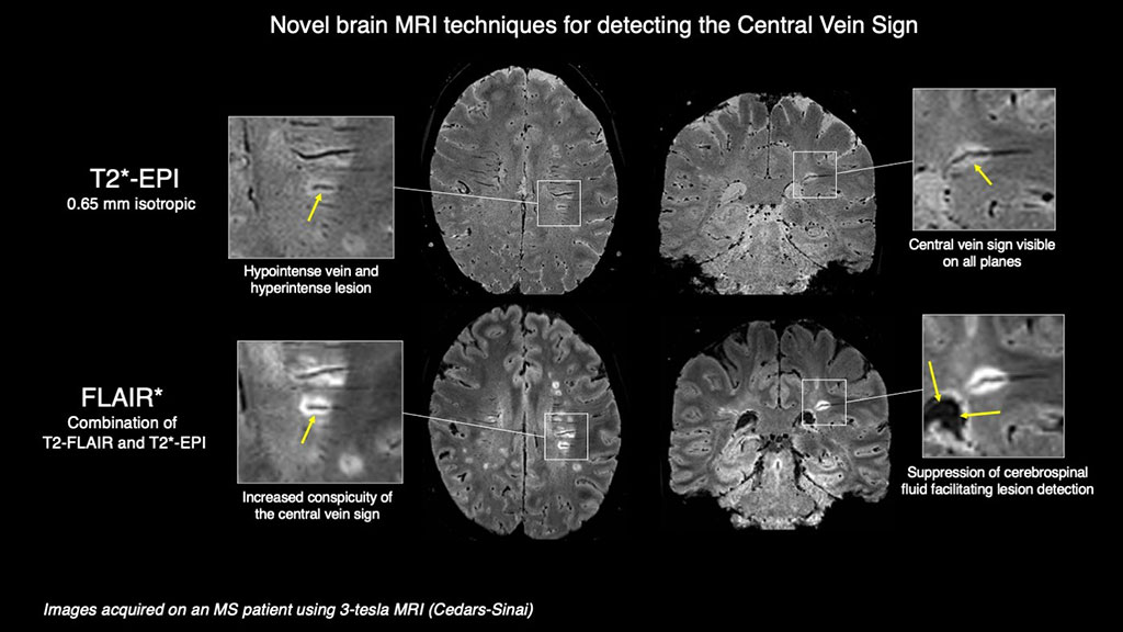 Imagen: Imágenes muestran nuevas técnicas de resonancias magnéticas cerebrales para detectar el signo de la vena central (Fotografía cortesía de Cedars-Sinai) Imagen: Imágenes muestran nuevas técnicas de resonancias magnéticas cerebrales para detectar el signo de la vena central (Fotografía cortesía de Cedars-Sinai)