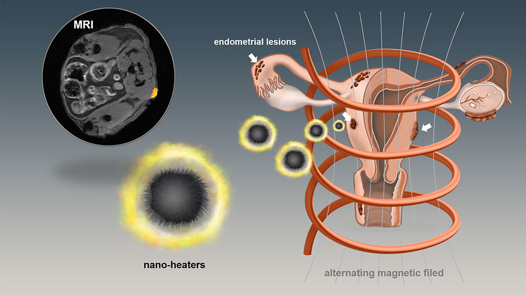 Imagen: Las nanopartículas se  muestran prometedoras para localizar, eliminar lesiones de endometriosis (Fotografía cortesía de OSU)