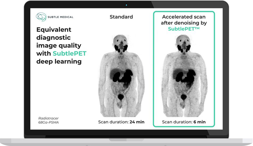 Imagen: Calidad de imagen de diagnóstico equivalente con Subtle PET AI (Fotografía cortesía de Subtle Medical) Imagen: Calidad de imagen de diagnóstico equivalente con Subtle PET AI (Fotografía cortesía de Subtle Medical)