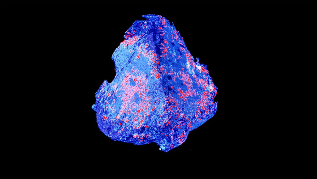 Imagen: Imagen de micro-CT 3D de un coágulo de sangre de 1,5 milímetros de ancho (Fotografía cortesía de Empa)