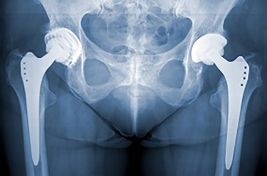Imagen: La cirugía asistida por robot para el reemplazo de la cadera tiene una tasa de complicaciones más baja que el método tradicional (Fotografía cortesía de Henry Ford Health)