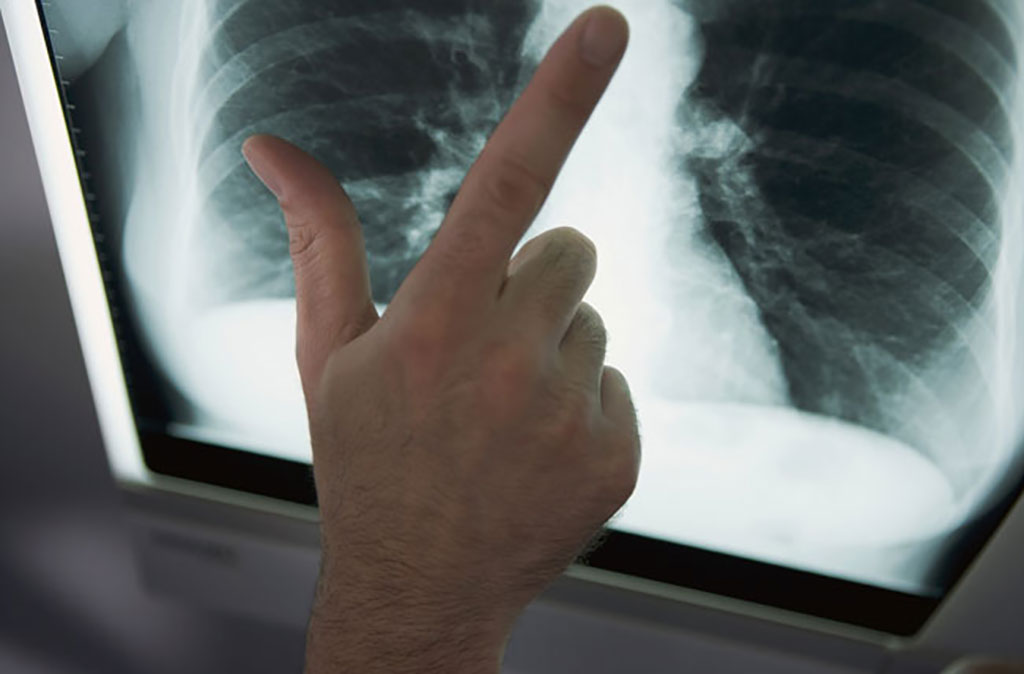 Imagen: La tecnología de imágenes intraoperatorias hará más fácil y seguro eliminar los tumores en los pulmones (Fotografía cortesía de Penn Medicine)