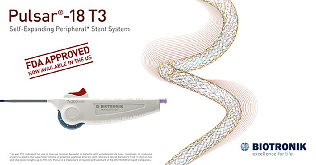 Imagen: Sistema de stent periférico autoexpandible Pulsar-18 T3 recibió la aprobación de la FDA (Fotografía cortesía de  BIOTRONIK)