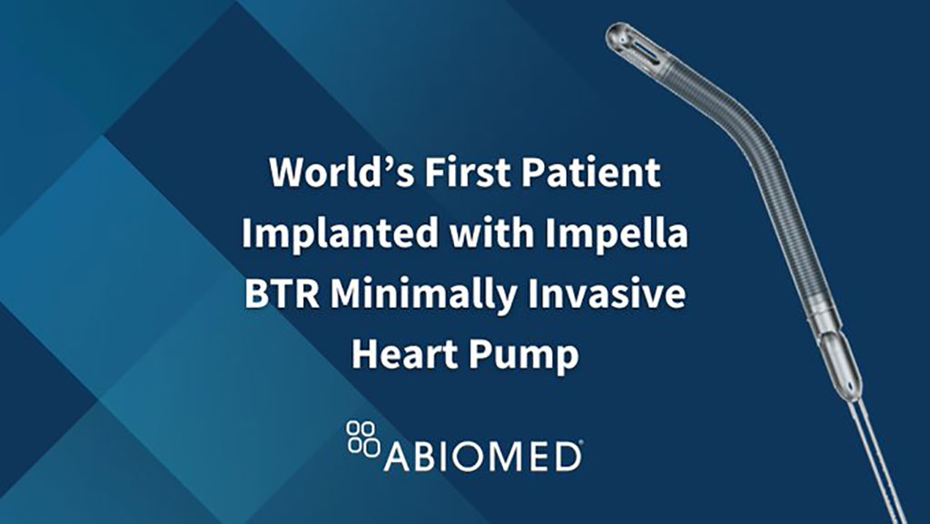 Imagen: El primer paciente del mundo ha sido implantado con Impella BTR bomba cardíaca mínimamente invasiva (Fotografía cortesía de Abiomed)