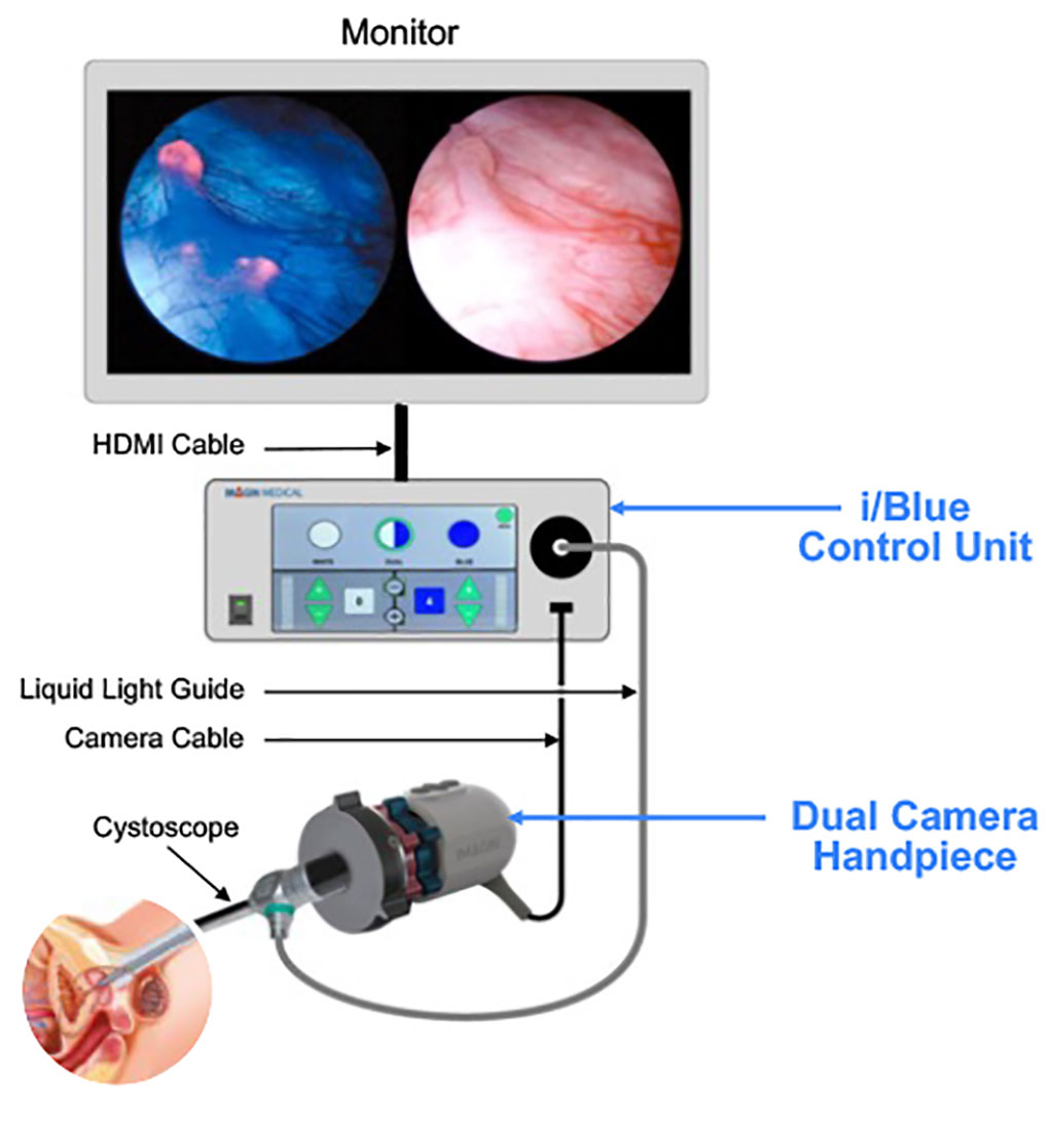 Imagen: El sistema i/Blue ofrece tecnología de imágenes de luz azul de última generación (Fotografía cortesía de Imagin Medical)