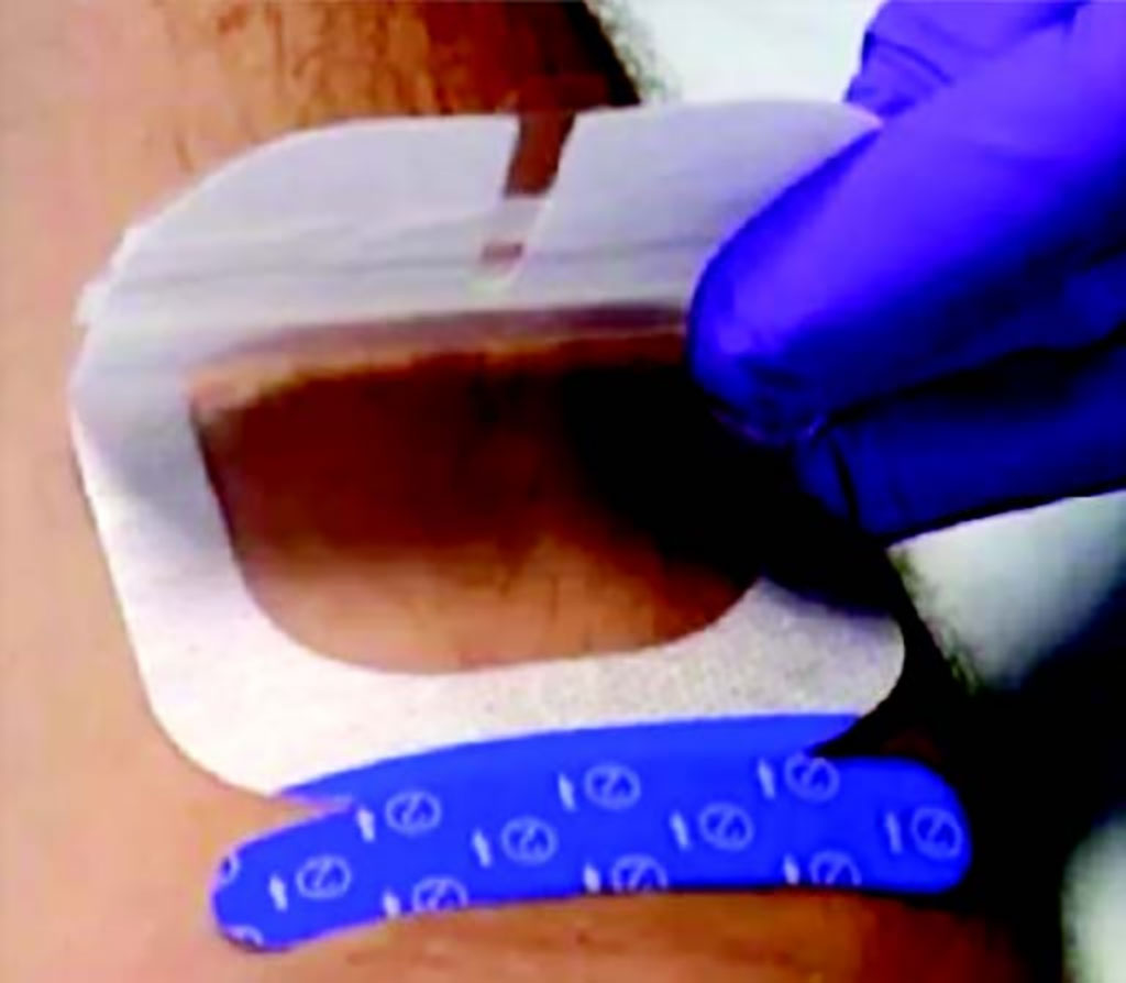 Imagen: Un innovadorapósito de barrera estéril, UltraDrape reduce significativamente costos y tiempo del personal (Fotografía cortesía de Parker Labs) Imagen: Un innovadorapósito de barrera estéril, UltraDrape reduce significativamente costos y tiempo del personal (Fotografía cortesía de Parker Labs)