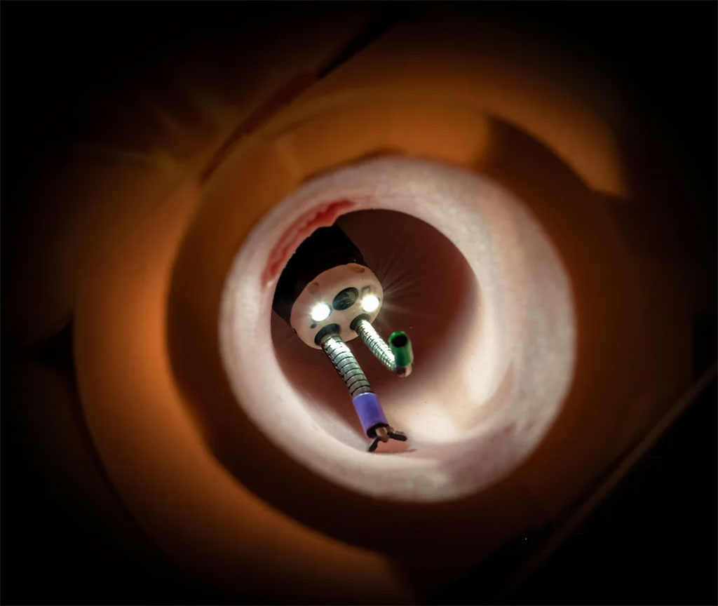 Imagen: EndoTheia recibió la designación de dispositivo innovador de la FDA para su tecnología para mejorar la cirugía endoscópica (Fotografía cortesía de EndoTheia)