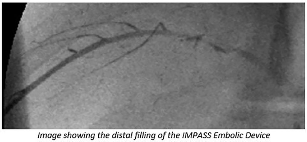 Imagen: Imagen que muestra el relleno distal del dispositivo embólico IMPASS (Fotografía cortesía de Fluidx Medical)