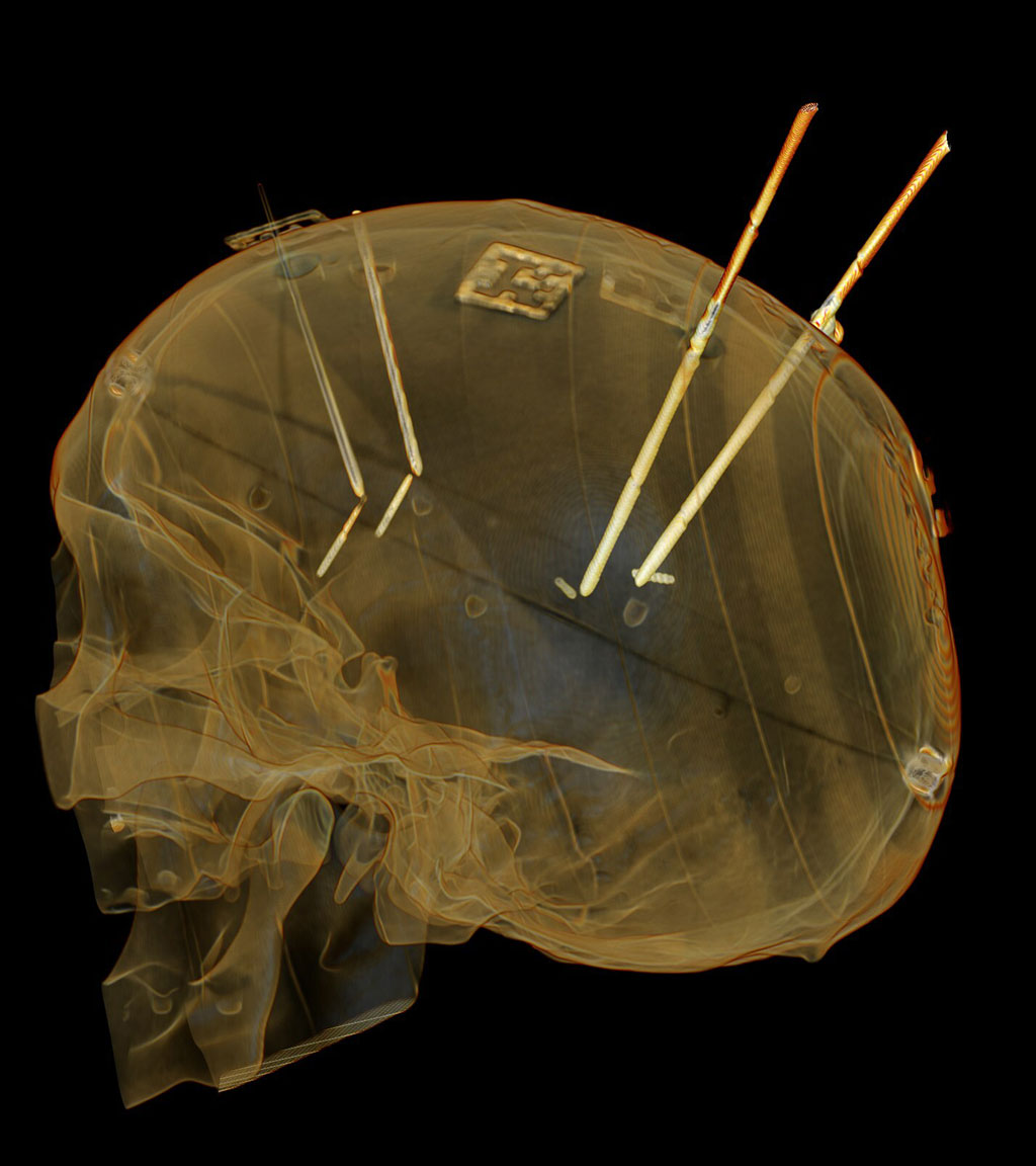 Imagen: Modelo fantasma de cráneo que muestra los instrumentos después de la colocación con VisAR (Fotografía cortesía de Novarad)