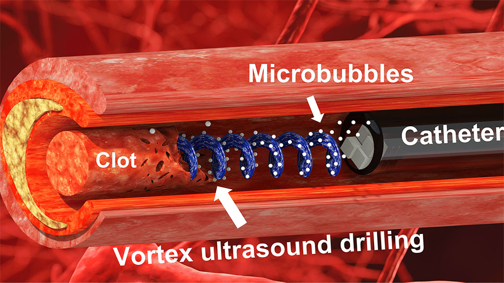 Imagen: La nueva herramienta utiliza "ultrasonido de vórtice" para disolver los coágulos cerebrales (Fotografía cortesía de CDC, Stephanie Rossow) Imagen: La nueva herramienta utiliza "ultrasonido de vórtice" para disolver los coágulos cerebrales (Fotografía cortesía de CDC, Stephanie Rossow)
