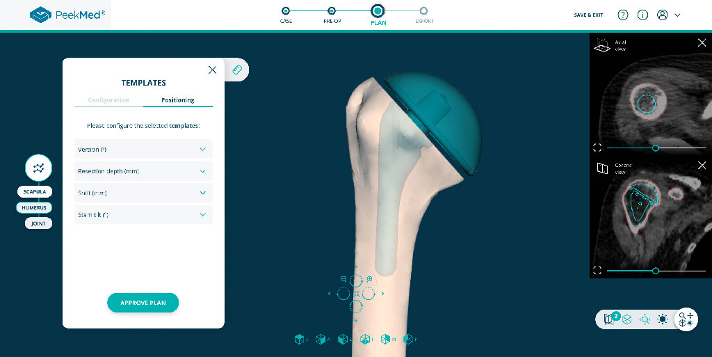 Imagen: La nueva solución ortopédica avanzada de AI ha recibido la autorización 510 (k) de la FDA  de los EUA (Fotografía cortesía de PeekMed)