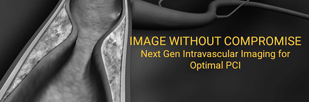 Imagen: El sistema de imágenes HyperVue está destinado a la obtención de imágenes de las arterias coronarias (Fotografía cortesía de SpectraWAVE)