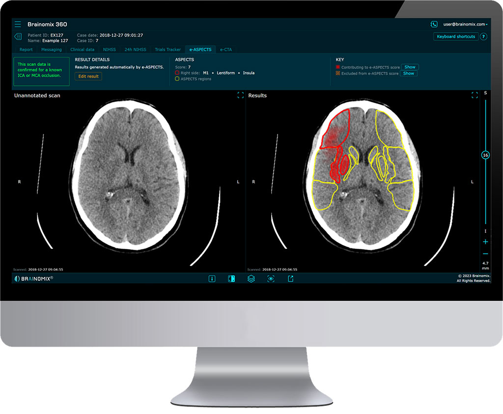 Imagen: El software de imágenes de accidente cerebrovascular con IA Brainomix 360 E-ASPECTS ha recibido la autorización de la FDA (Fotografía cortesía de Brainomix) Imagen: El software de imágenes de accidente cerebrovascular con IA Brainomix 360 E-ASPECTS ha recibido la autorización de la FDA (Fotografía cortesía de Brainomix)