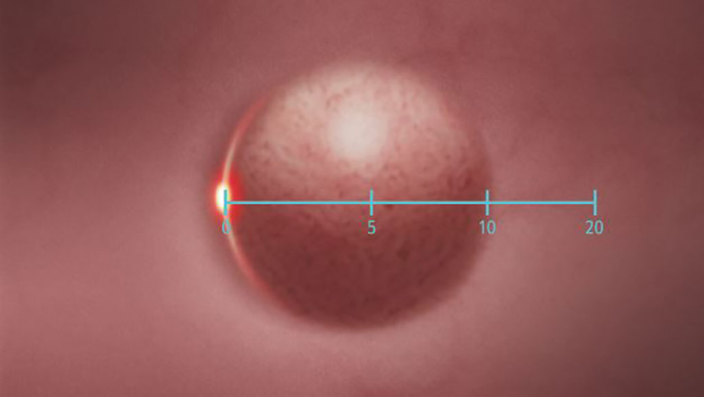 Imagen: SCALE EYE ayuda a los endoscopistas a estimar el tamaño de las lesiones en el colon (Fotografía cortesía de FUJIFILM)