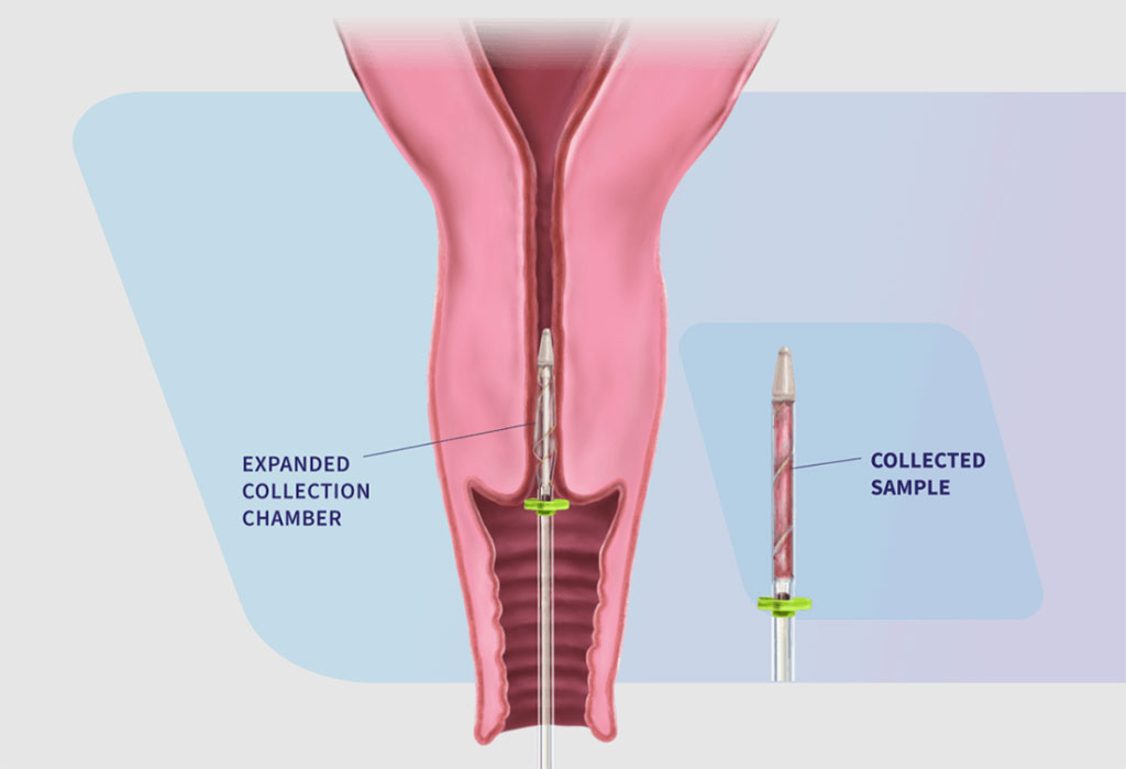 Imagen: FemCerv es el primer y único método para la toma de muestra completa de tejidos para el diagnóstico de cáncer de cuello uterino (Fotografía cortesía de Femasys)