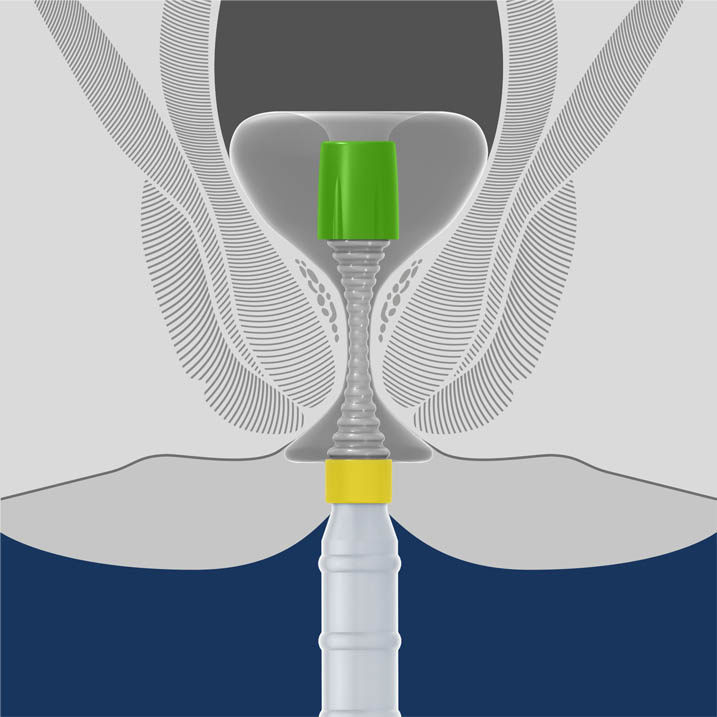 El innovador sistema de catéter hygh-tec está diseñado para el drenaje de heces en la UCI (Fotografía cortesía de Advanced Medical Balloons)