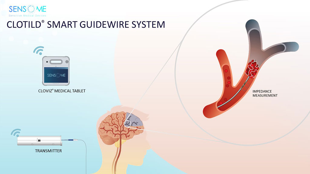 Imagen: El Clotild Smart Guidewire es un dispositivo innovador para el tratamiento del accidente cerebrovascular isquémico agudo (Fotografía cortesía de Sensome)