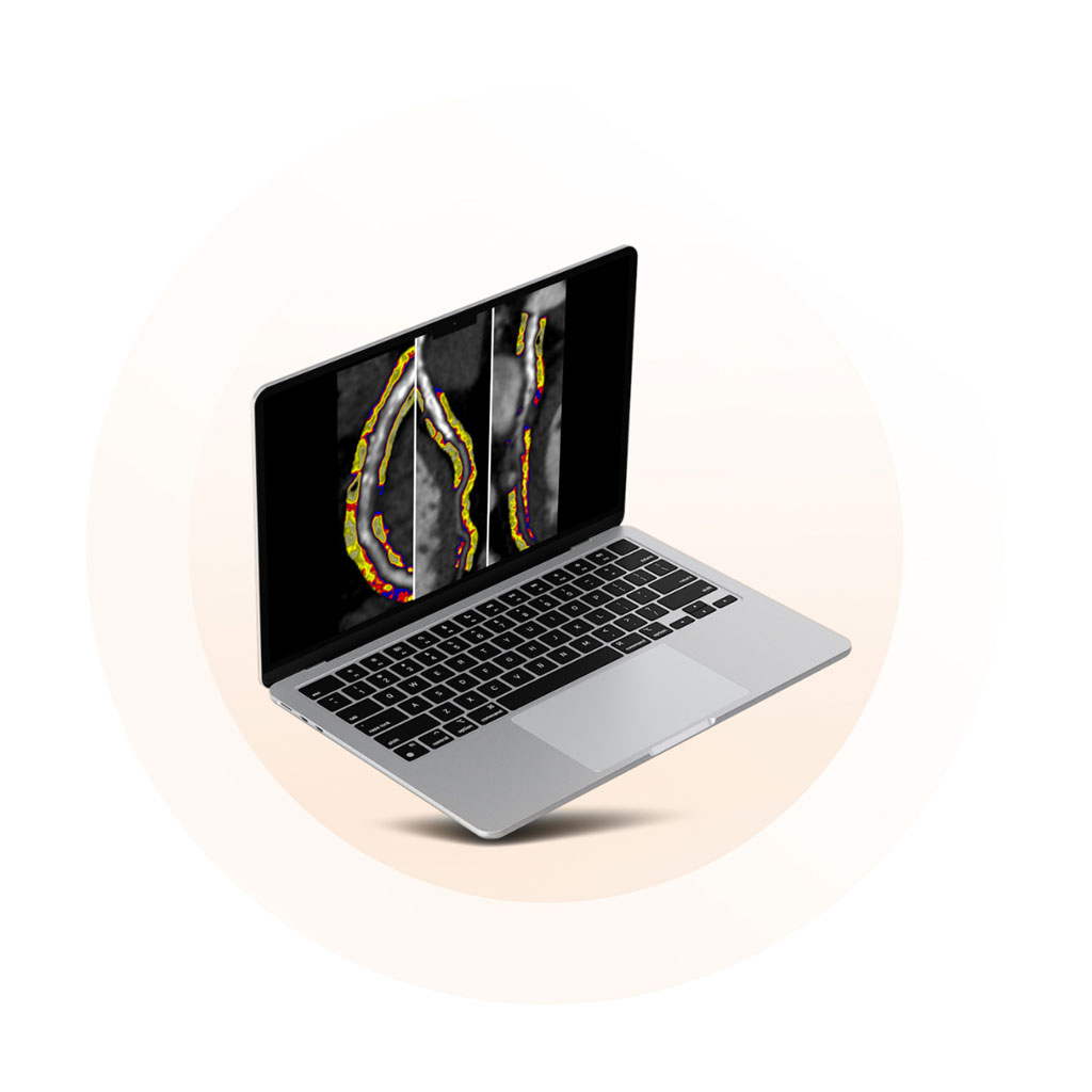 Imagen: La tecnología Cari-Heart eleva el listón para la gestión de la EAC cuantificando tanto la inflamación coronaria como la placa (Fotografía cortesía de Caristo Diagnostics) Imagen: La tecnología Cari-Heart eleva el listón para la gestión de la EAC cuantificando tanto la inflamación coronaria como la placa (Fotografía cortesía de Caristo Diagnostics)
