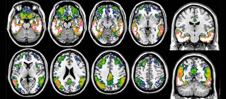 Imagen: Imágenes de tau con PET 18F-Flortaucipir en la enfermedad de Alzheimer (Fotografía cortesía de UNIGE)