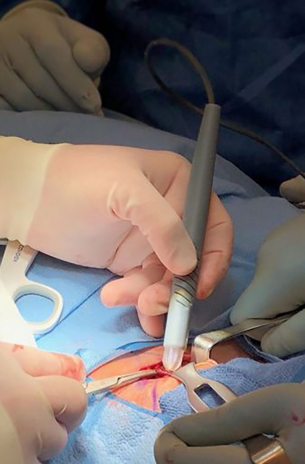 Imagen: El bolígrafo MasSpec Pen utilizado para sondear el tejido durante la cirugía (Fotografía cortesía de la Facultad de Medicina de Baylor)