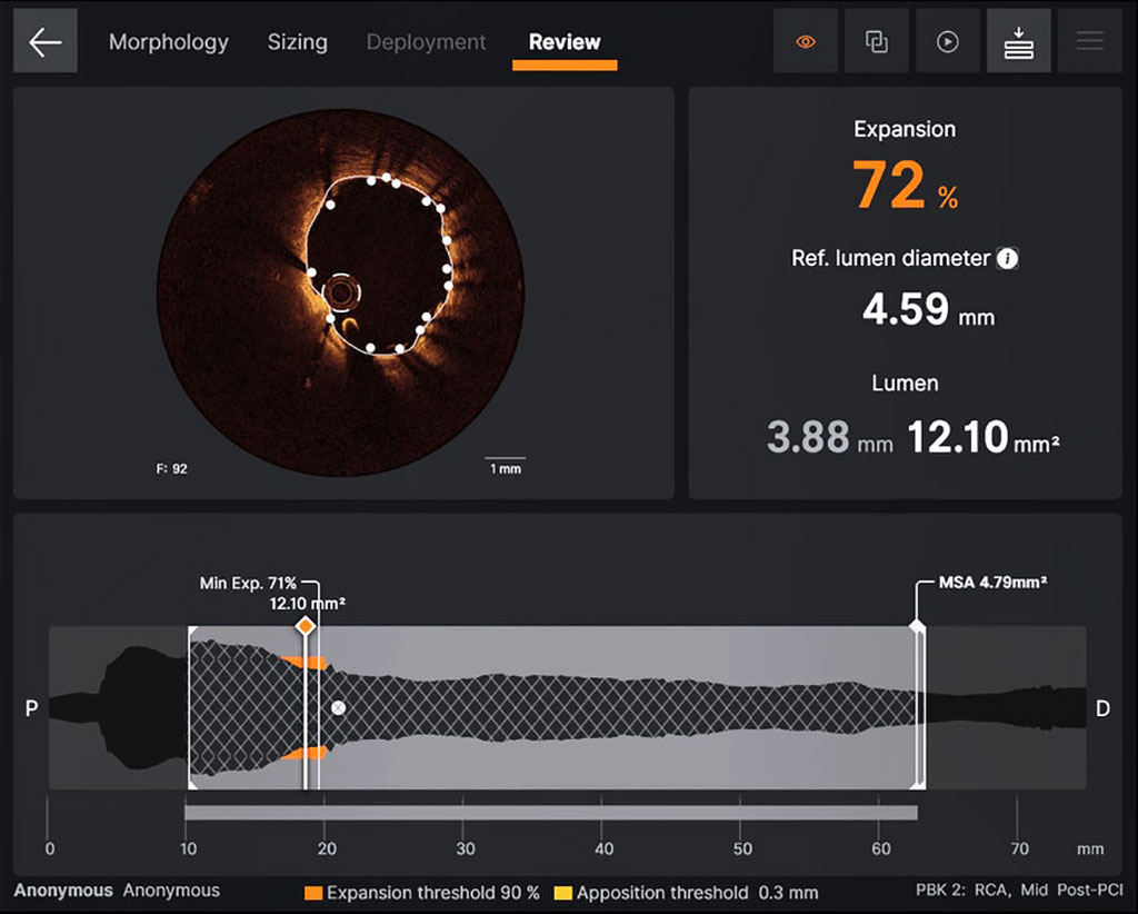 Imagen: El software Ultreon 1.0 está diseñado para optimizar la colocación de stent (Fotografía cortesía de Abbott) Imagen: El software Ultreon 1.0 está diseñado para optimizar la colocación de stent (Fotografía cortesía de Abbott)
