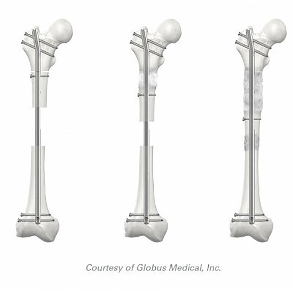 Imagen: El sistema de transporte óseo Precice está diseñado para tratar defectos óseos segmentarios de hasta 10 cm. (Fotografía cortesía de Globus Medical)