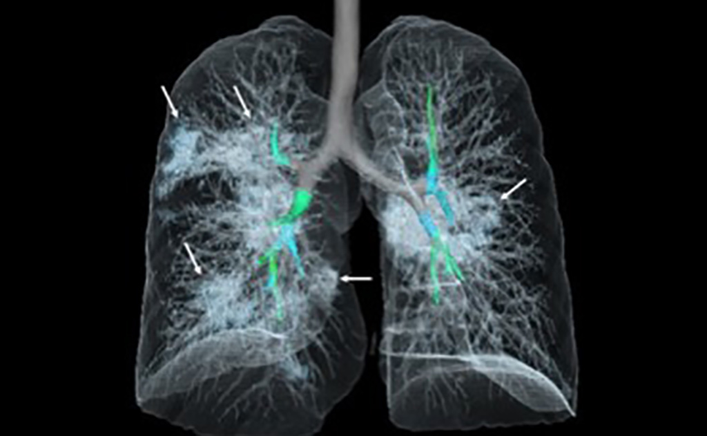 Imagen: Los radiólogos superaron a la IA en la identificación de enfermedades pulmonares en radiografías de tórax (Fotografía cortesía de RSNA) Imagen: Los radiólogos superaron a la IA en la identificación de enfermedades pulmonares en radiografías de tórax (Fotografía cortesía de RSNA)