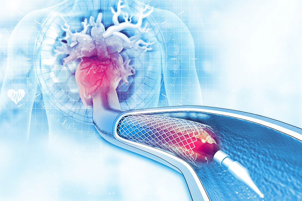 Imagen: El acceso radial para las intervenciones de las arterias periféricas ha demostrado estar asociado con perfiles de seguridad favorables (Fotografía cortesía de 123RF)