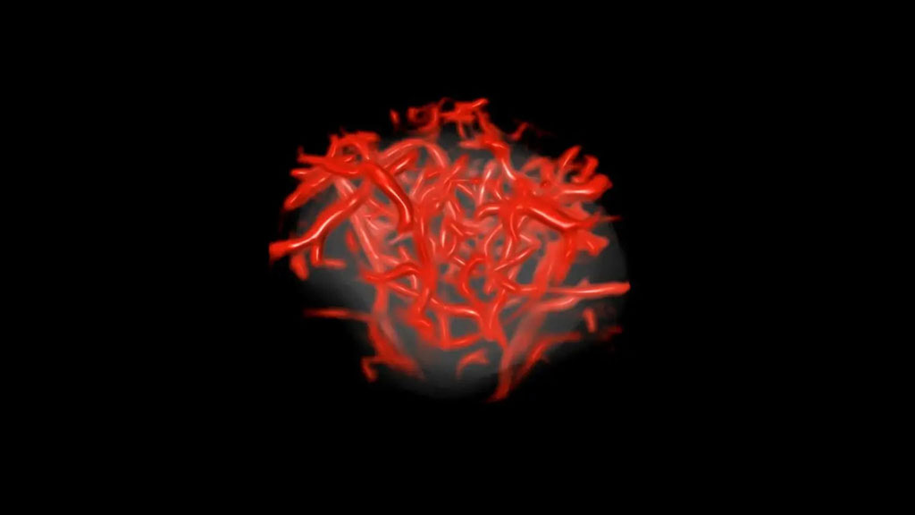 Imagen: Los investigadores avanzan en las imágenes de microvasos de ultrasonido e IA para mejorar la detección del cáncer (Fotografía cortesía de la Clínica Mayo) Imagen: Los investigadores avanzan en las imágenes de microvasos de ultrasonido e IA para mejorar la detección del cáncer (Fotografía cortesía de la Clínica Mayo)