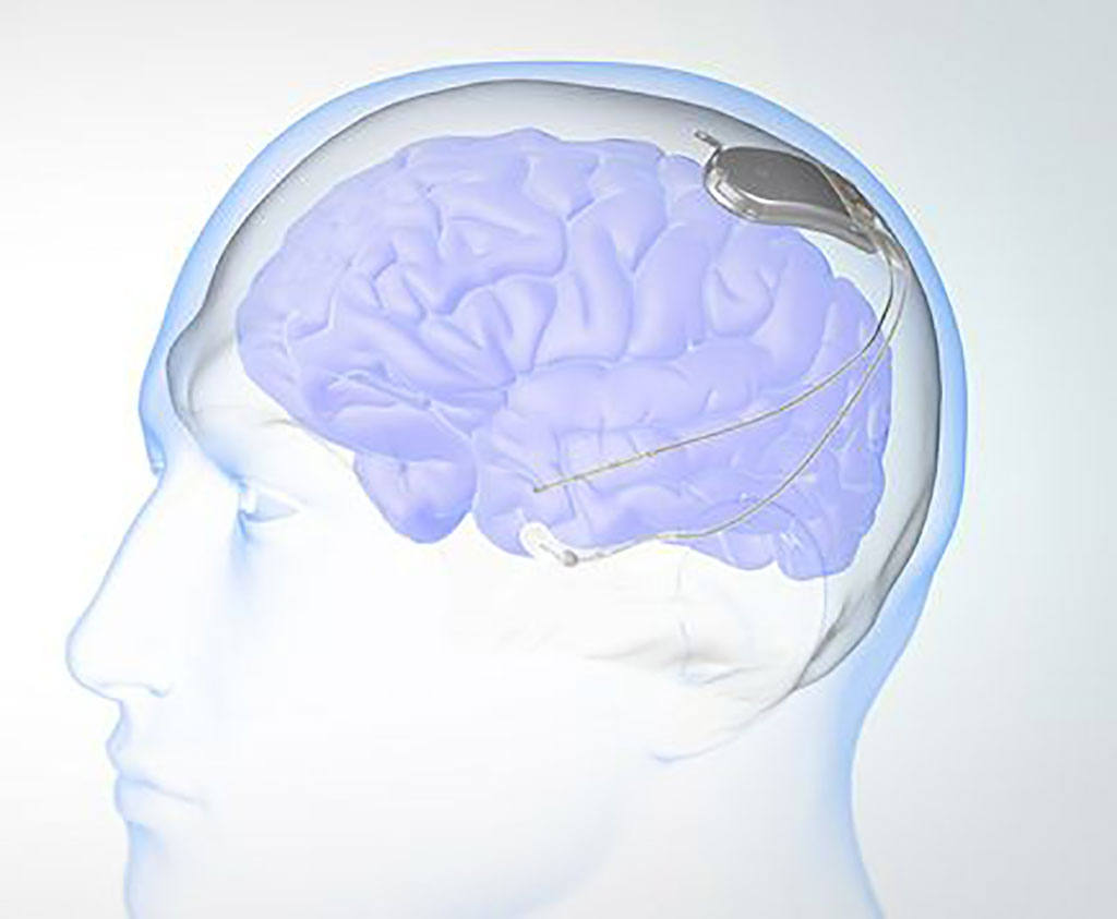 Imagen: Por primera vez, un electrodo se dirige a dos porciones de cerebro para beneficio doble (Fotografía cortesía de OHSU)