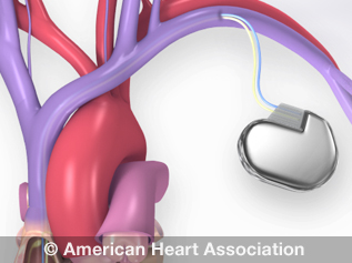 Imagen: El marcapasos experimental convierte la energía de los latidos del corazón para recargar la batería (Fotografía cortesía de la American Heart Association)