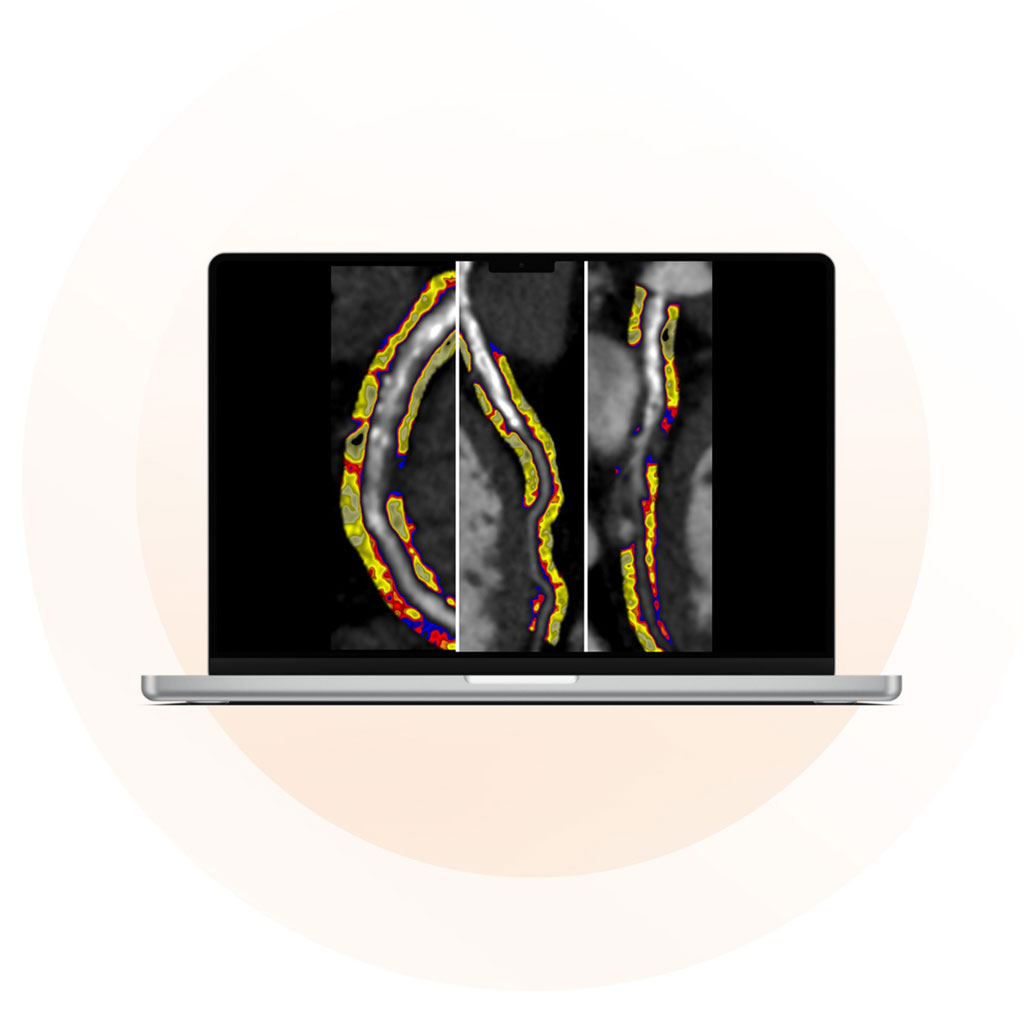 Imagen: La solución de análisis de imágenes CaRi-Heart aplica IA a las imágenes estándar de ACTC (Fotografía cortesía de Caristo Diagnostics) Imagen: La solución de análisis de imágenes CaRi-Heart aplica IA a las imágenes estándar de ACTC (Fotografía cortesía de Caristo Diagnostics)