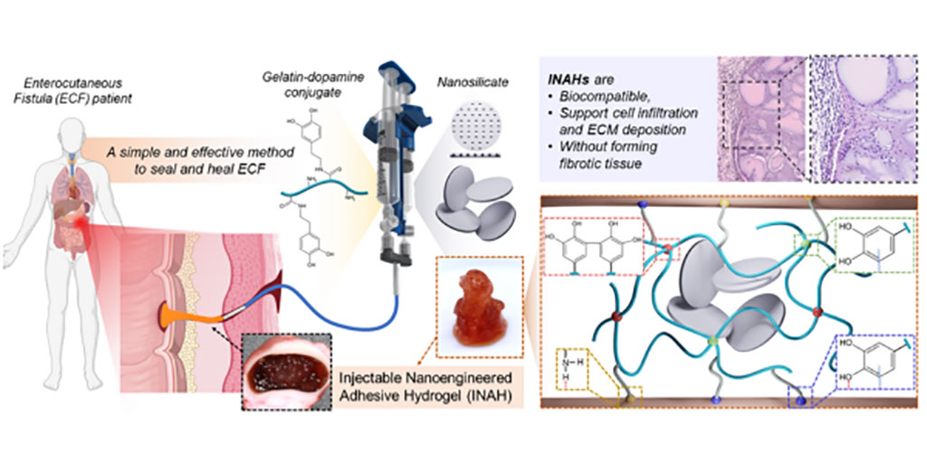 Imagen: El gel se ha desarrollado para sellar y curar desafiantes conexiones gastrointestinales del tracto a piel (Fotografía cortesía del Instituto Terasaki)