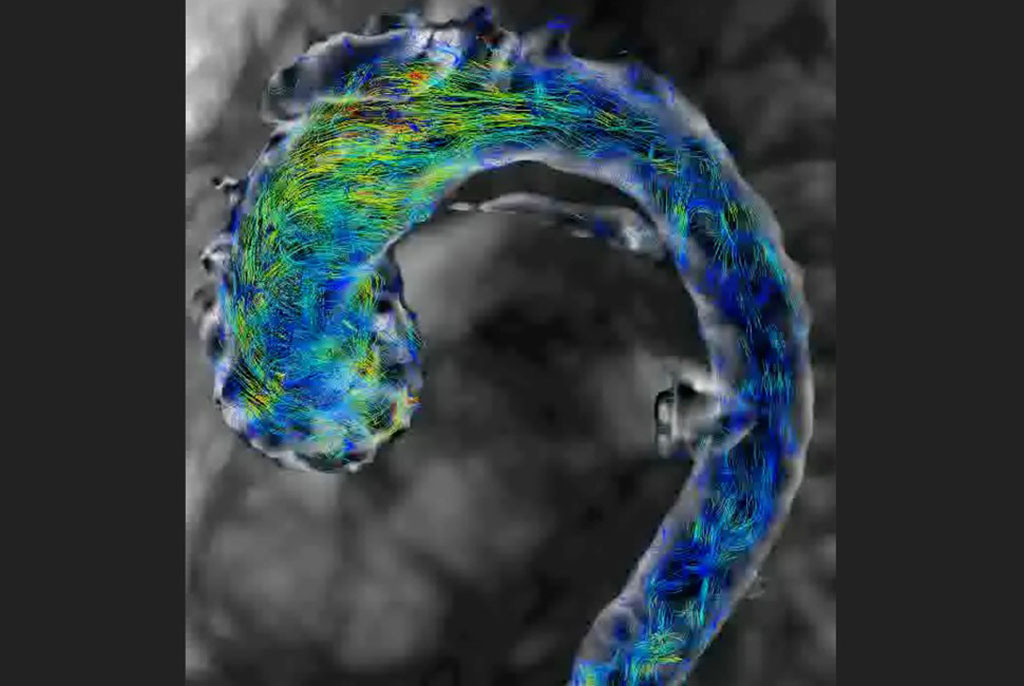 Imagen: Una exploración de resonancia magnética 4D de flujo de una aorta humana (Fotografía cortesía de Ethan Johnson) Imagen: Una exploración de resonancia magnética 4D de flujo de una aorta humana (Fotografía cortesía de Ethan Johnson)