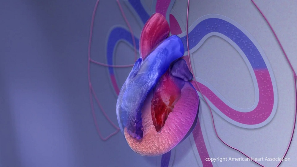 Imagen: Una animación gráfica generada por computadora de miocardiopatía (Fotografía cortesía de American Heart Association)