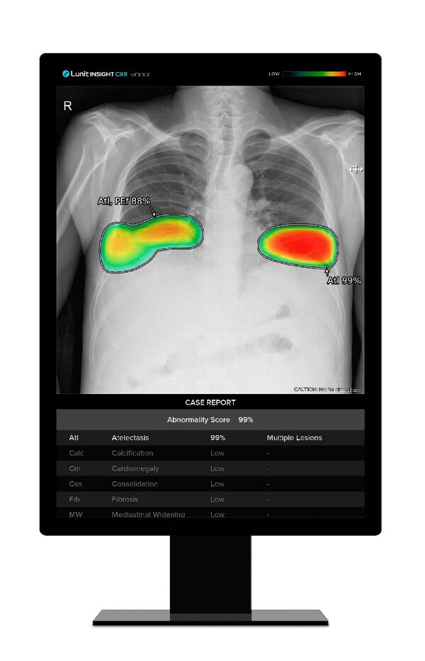 Imagen: La solución de análisis de radiografías de tórax impulsada por IA Lunit INSIGHT CXR (Fotografía cortesía de Lunit) Imagen: La solución de análisis de radiografías de tórax impulsada por IA Lunit INSIGHT CXR (Fotografía cortesía de Lunit)