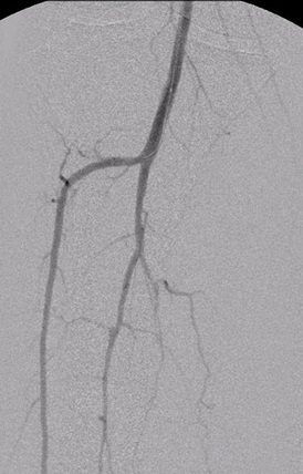 Imagen: Angiograma de la pantorrilla obtenido utilizando el catéter Summa Finesse con 1 ml de equivalente del 60 % de contraste (Fotografía cortesía de Summa Therapeutics)