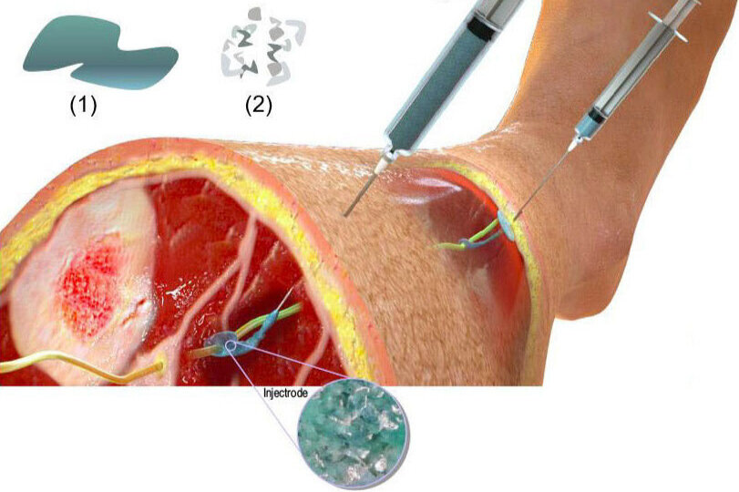 Imagen: El electrodo flexible se puede inyectar en el cuerpo para estimular los nervios dañados y aliviar el dolor crónico (Fotografía cortesía de Neuronoff)