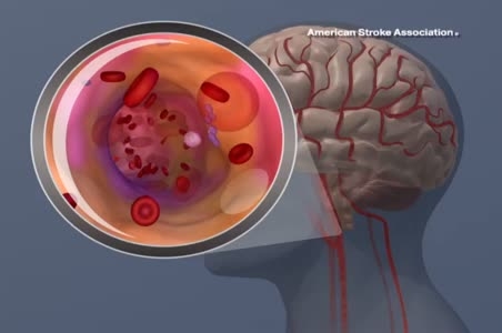 Imagen: Animación de accidente cerebrovascular isquémico (Fotografía cortesía de la Asociación Americana de Accidentes Cerebrovasculares)