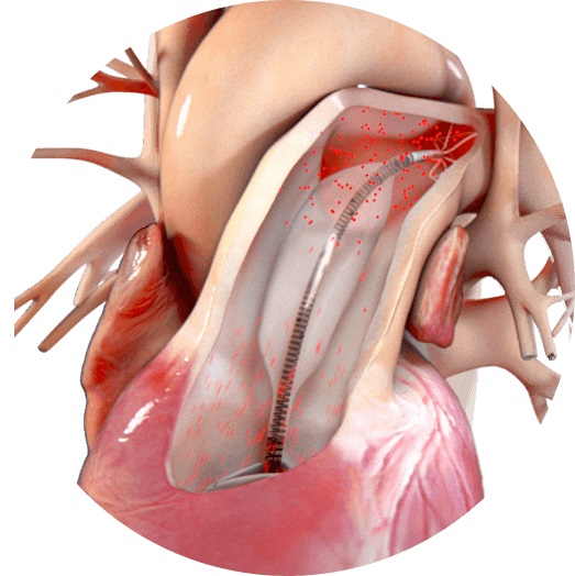 Imagen: El globo flexible lleno de gas se coloca en la arteria pulmonar principal y se conecta por un catéter a un depósito hueco (Fotografía cortesía de Aria CV)
