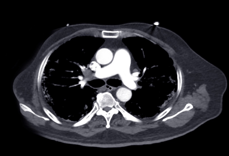 Imagen: La puntuación de calcio de la arteria coronaria es predictiva de ataques cardíacos y accidentes cerebrovasculares (Fotografía cortesía de 123RF)