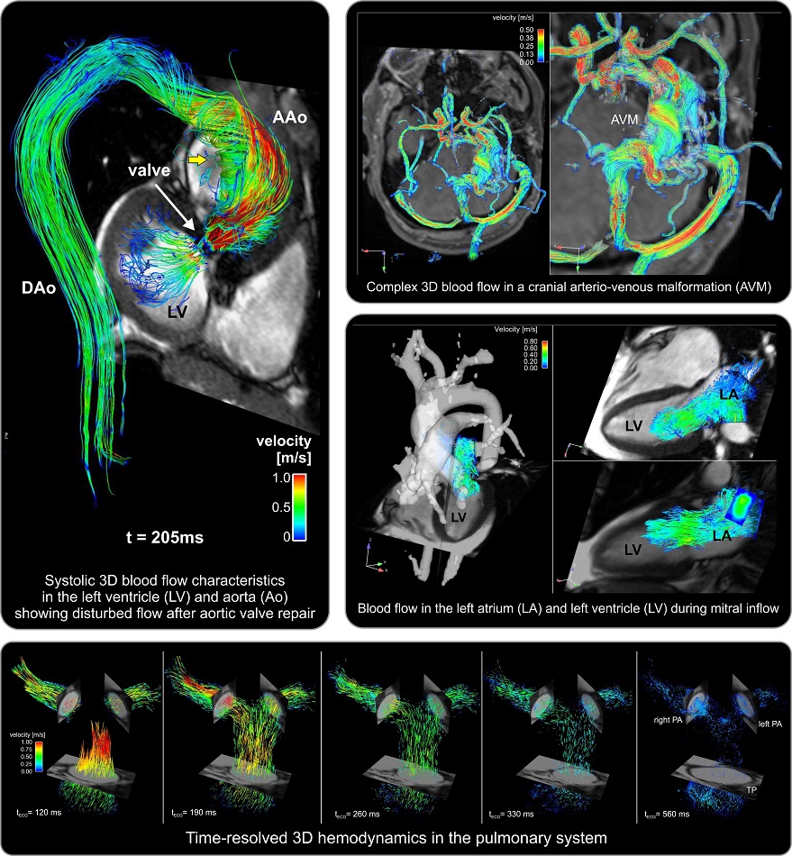 Imagen: Resonancia magnética 4D Flow permite una evaluación in vivo sin obstáculos de la velocidad de la sangre 3D resuelta en el tiempo (Fotografía cortesía de la Universidad Northwestern)