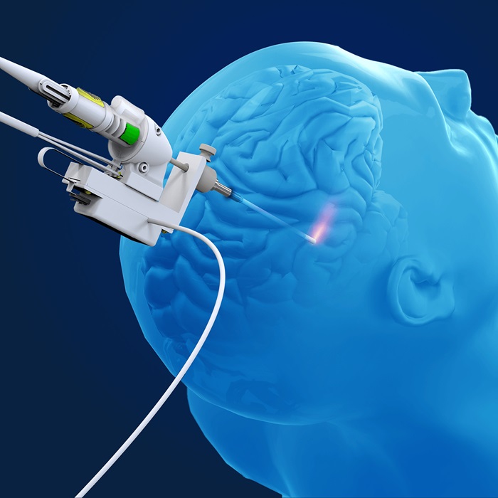 Imagen: La sonda láser Neuroblate NB3 Fullfire está destinada a su uso con el sistema NeuroBlate (foto cortesía de Monteris Medical)