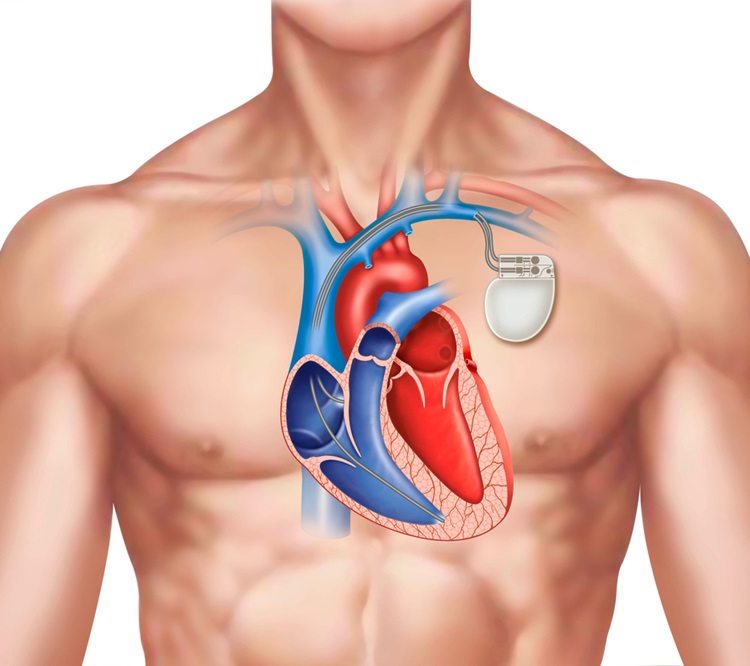 Imagen: EL recubrimiento adhesivo de hidrogel elimina la acumulación de tejido cicatricial a su alrededor (foto cortesía de IlusMedical/Shutterstock)