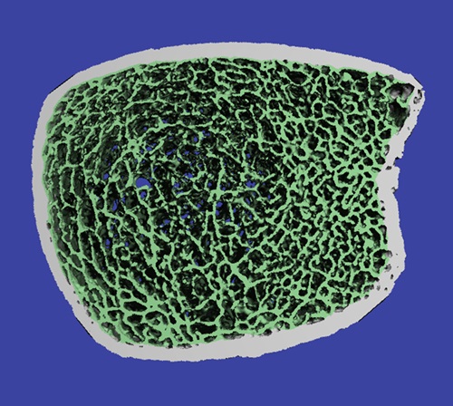 Imagen: La imagen HR-PQCT muestra la microarquitectura del hueso trabecular (en verde) y el hueso cortical (en blanco) dentro de la tibia distal (foto cortesía de la Universidad de Wake Forest) Imagen: La imagen HR-PQCT muestra la microarquitectura del hueso trabecular (en verde) y el hueso cortical (en blanco) dentro de la tibia distal (foto cortesía de la Universidad de Wake Forest)