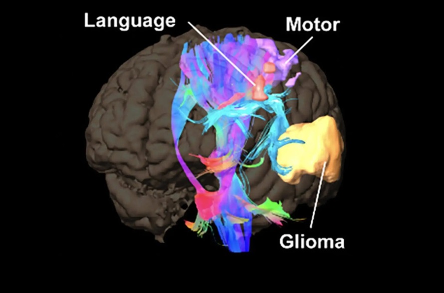 Imagen: Las mutaciones de cáncer cerebral identificadas durante la cirugía (foto cortesía de Mayo Clinic)