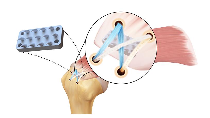 Imagen: El esquema del dispositivo inspirado en un diente de pitón interpuesto entre un tendón y un hueso mejora significativamente la reparación estándar del manguito rotador (foto cortesía de Iden Kurtaliaj/Columbia Engineering)