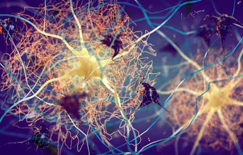 Imagen: Un nuevo estudio ha validado una herramienta de diagnóstico para identificar placas de beta amiloide, un sello clave de la enfermedad de Alzheimer (foto cortesía de Shutterstock)